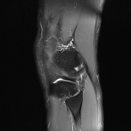 File:Anterior cruciate ligament full thickness tear (Radiopaedia 66268-75467 Sagittal PD fat sat 20).jpg