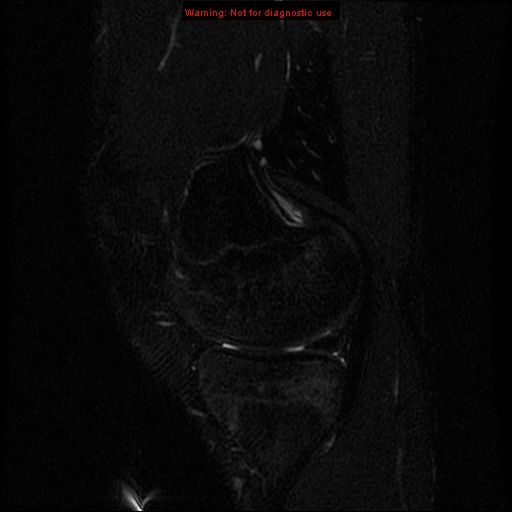 File:Anterior cruciate ligament injury - partial thickness tear (Radiopaedia 12176-12515 Sagittal T2 fat sat 6).jpg