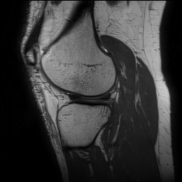 Anterior cruciate ligament rupture and posteromedial corner injury (Radiopaedia 67338-76723 Sagittal PD 122).jpg