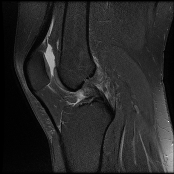 File:Anterior cruciate ligament tear, Wrisberg rip and bucket-handle tear of medial meniscus (Radiopaedia 75872-87266 Sagittal PD fat sat 13).jpg