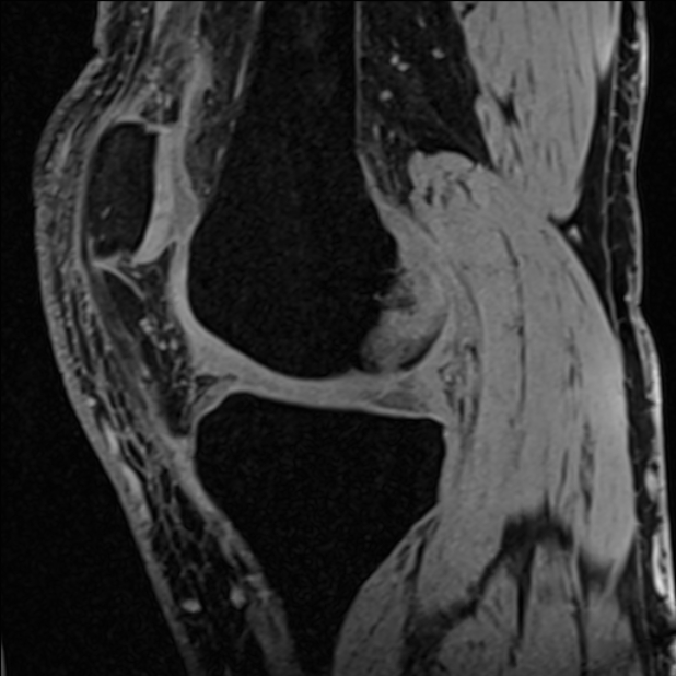 Anterior cruciate ligament tear - ramp lesion (Radiopaedia 71883-82322 Sagittal T1 vibe 88).jpg