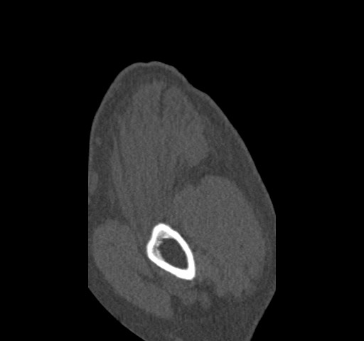 Anterior glenohumeral dislocation with Hill-Sachs lesion (Radiopaedia 62877-71249 Sagittal bone window 7).jpg