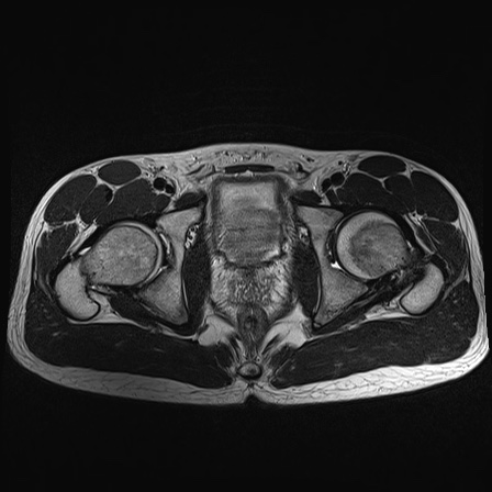 File:Anterior inferior iliac spine avulsion fracture (Radiopaedia 81312-95000 Axial T2 14).jpg