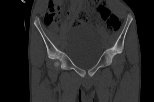 Anterior inferior iliac spine avulsion injury (Radiopaedia 88666-105376 Coronal bone window 24).jpg