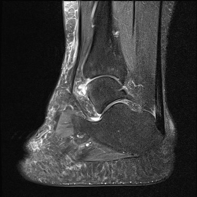 File:Anterior talofibular ligament injury - rupture with soft-tissue impingement (Radiopaedia 38765-40928 Sagittal PD fat sat 14).jpg