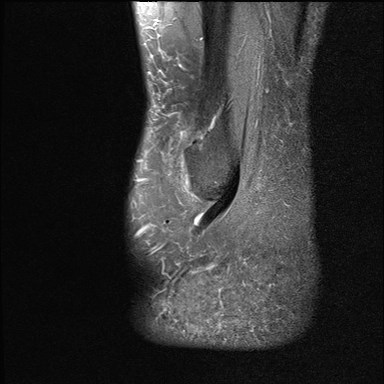 File:Anterior talofibular ligament injury - rupture with soft-tissue impingement (Radiopaedia 38765-40928 Sagittal PD fat sat 19).jpg