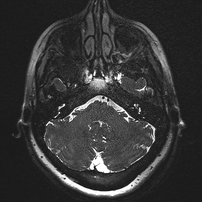 Anterior temporal encephalocele (Radiopaedia 82624-96808 Axial T2 high res 4).jpg