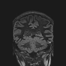 Anterior temporal encephalocele (Radiopaedia 82624-96808 Coronal FLAIR 35).jpg