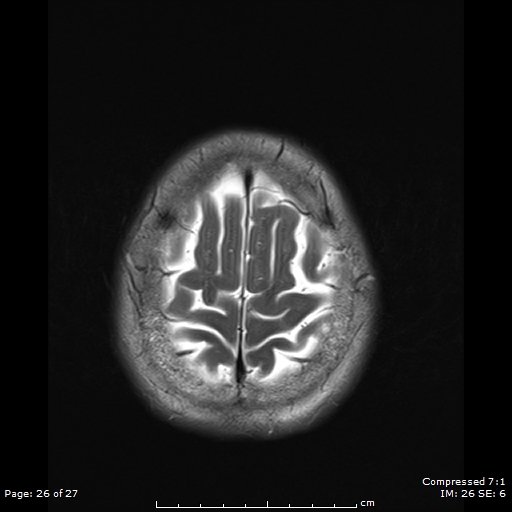 File:Anterior temporal lobe perivascular space (Radiopaedia 88283-104914 Axial T2 26).jpg