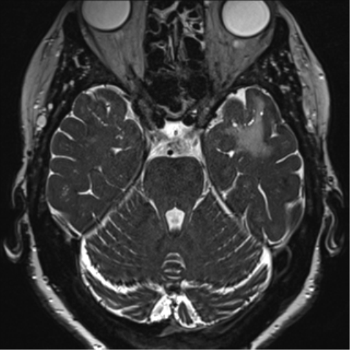 Anterior temporal pole cysts (Radiopaedia 46629-51102 Axial 31).png