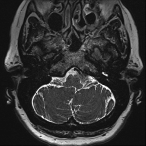 Anterior temporal pole cysts (Radiopaedia 46629-51102 Axial T2 20).png