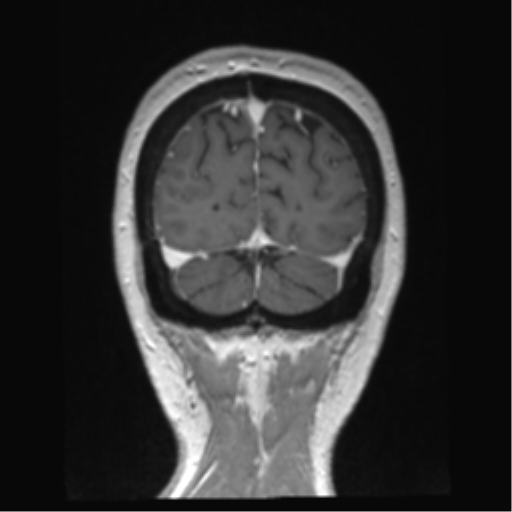 Anterior temporal pole cysts (Radiopaedia 46629-51102 Coronal T1 C+ 26).png