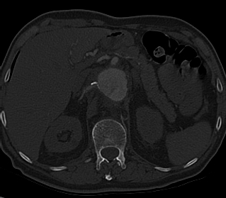 File:Anterior vertebral scalloping (abdominal aortic aneurysm) (Radiopaedia 66744-76067 Axial bone window 38).jpg