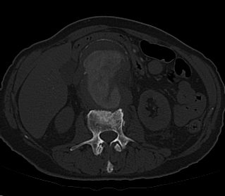 File:Anterior vertebral scalloping (abdominal aortic aneurysm) (Radiopaedia 66744-76067 Axial bone window 7).jpg