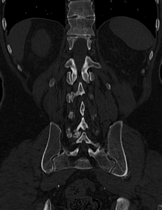 Anterior vertebral scalloping (abdominal aortic aneurysm) (Radiopaedia 66744-76067 Coronal bone window 55).jpg