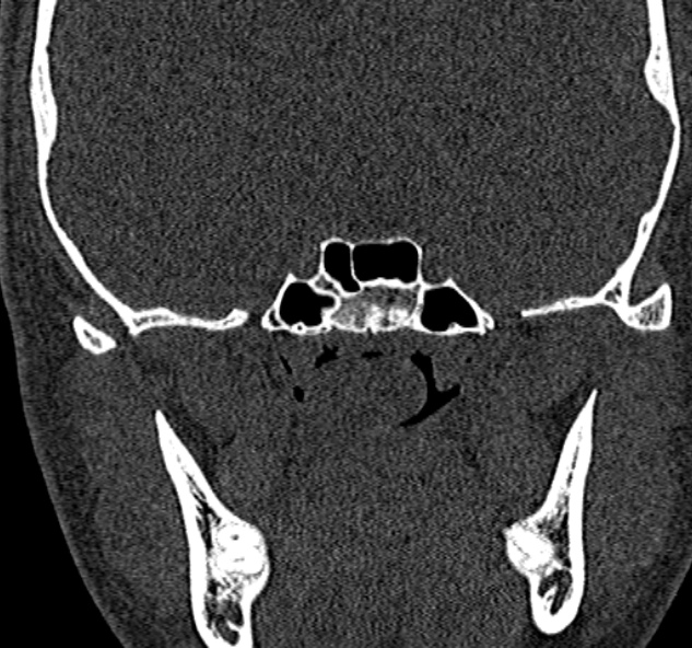 Antrochoanal polyp (Radiopaedia 30002-30554 Coronal bone window 70).jpg