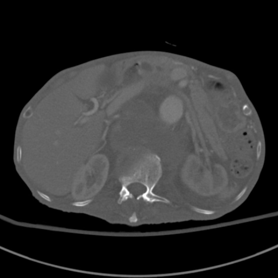 Aortic aneurysm with spinal destruction (Radiopaedia 42301-45410 Axial bone window 30).jpg