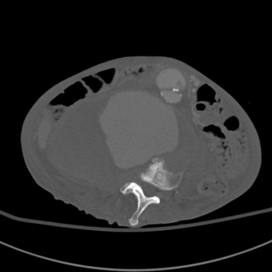 Aortic aneurysm with spinal destruction (Radiopaedia 42301-45410 Axial bone window 56).jpg