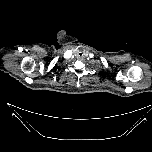 File:Aortic arch aneurysm (Radiopaedia 84109-99365 B 21).jpg