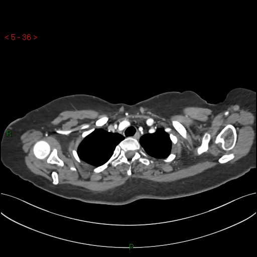 Aortic arch origin of left vertebral artery (Radiopaedia 51520-57286 A 35).jpg