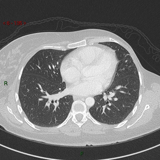 Aortic arch origin of left vertebral artery (Radiopaedia 51520-57286 Axial lung window 135).jpg