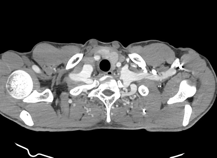 File:Aortic coarctation with aneurysm (Radiopaedia 74818-85828 A 179).jpg