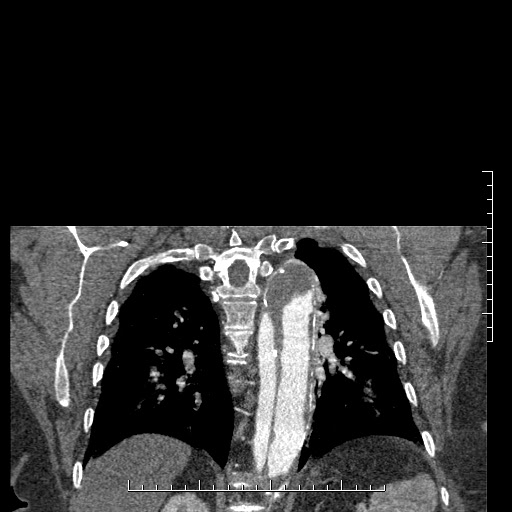 Aortic dissection- Stanford A (Radiopaedia 35729-37268 E 5).jpg
