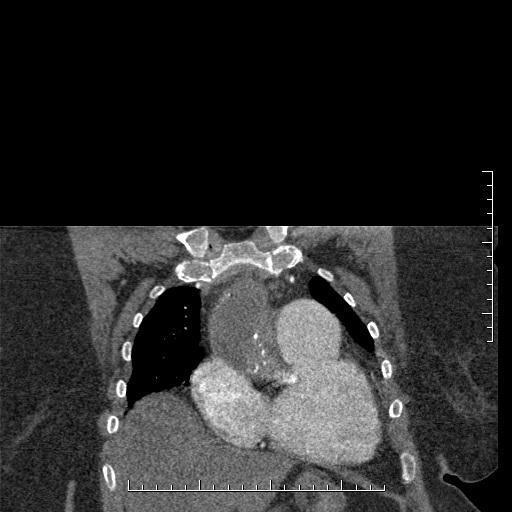Aortic dissection- Stanford A (Radiopaedia 35729-37268 E 58).jpg