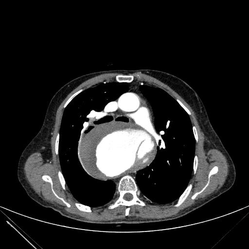Aortic dissection (Radiopaedia 27466-27665 C+ arterial phase 92).jpg