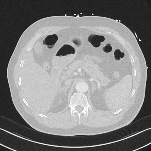 File:Aortic dissection (Radiopaedia 50763-56234 Axial lung window 65).png