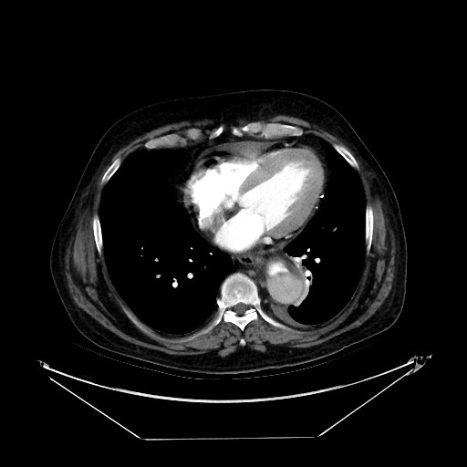 Aortic dissection (Radiopaedia 62562-71000 A 29).jpg