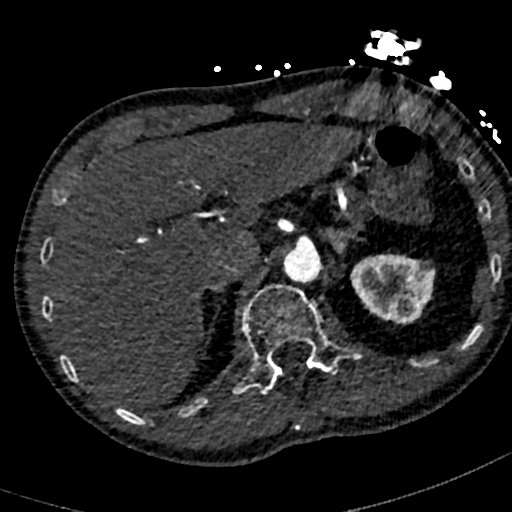 File:Aortic dissection - DeBakey type II (Radiopaedia 64302-73082 A 90).png