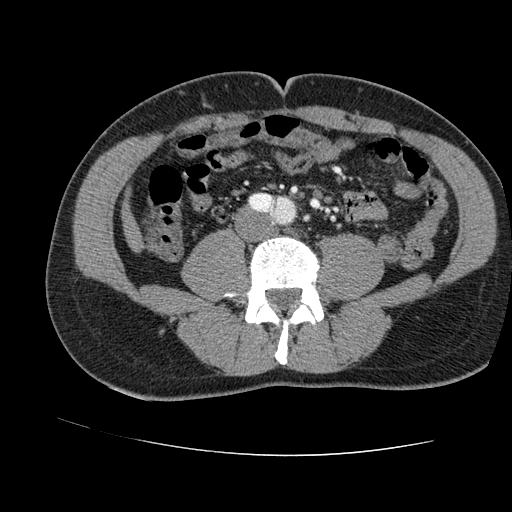 File:Aortic dissection - Stanford A -DeBakey I (Radiopaedia 28339-28587 B 156).jpg
