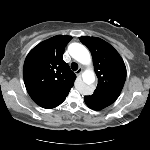 Aortic dissection - Stanford type B (Radiopaedia 50171-55512 A 15).png