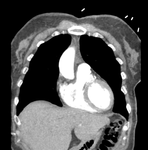 File:Aortic dissection - Stanford type B (Radiopaedia 50171-55512 B 22).png