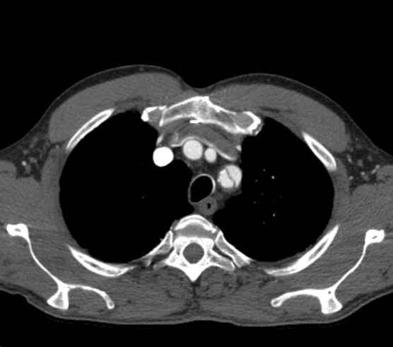 Aortic dissection - Stanford type B (Radiopaedia 73648-84437 A 10).jpg