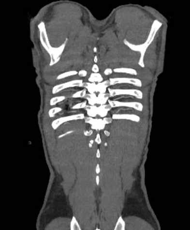 File:Aortic dissection - Stanford type B (Radiopaedia 73648-84437 B 109).jpg