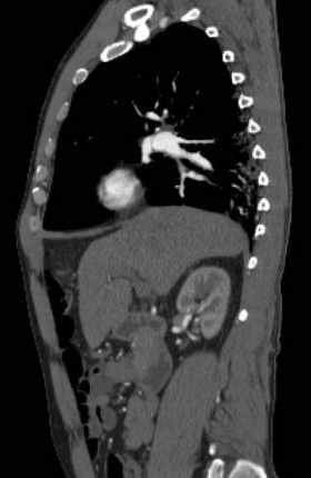 File:Aortic dissection - Stanford type B (Radiopaedia 73648-84437 C 101).jpg