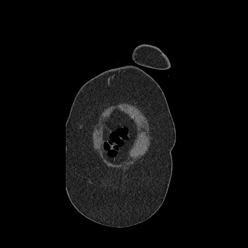Aortic dissection - Stanford type B (Radiopaedia 88281-104910 B 2).jpg