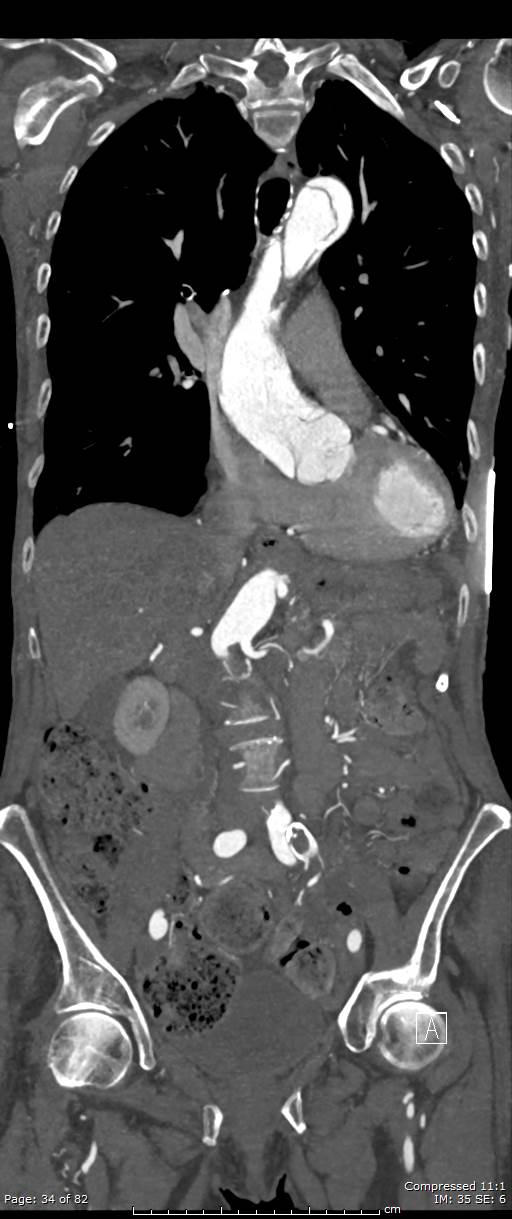 Aortic dissection with extension into aortic arch branches (Radiopaedia 64402-73204 A 34).jpg