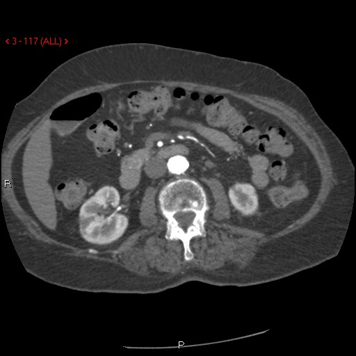 Aortic intramural hematoma (Radiopaedia 27746-28001 A 117).jpg