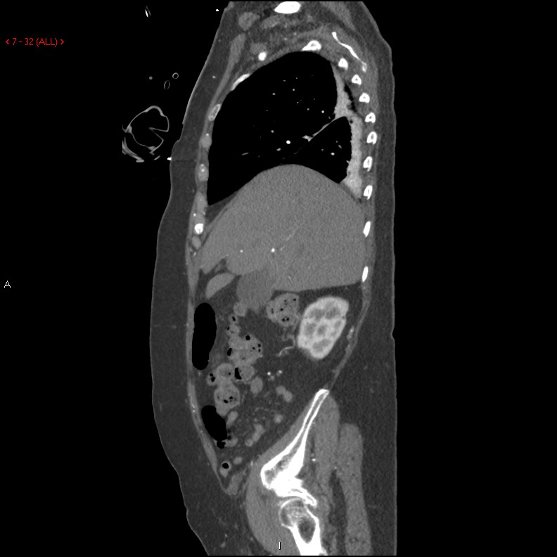 Aortic intramural hematoma (Radiopaedia 27746-28001 C 1).jpg