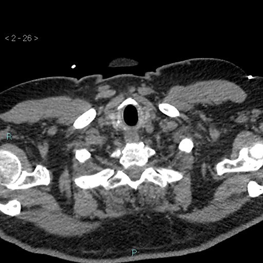 Aortic intramural hematoma (Radiopaedia 48463-53380 Axial non-contrast 12).jpg