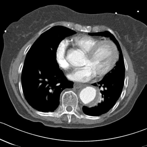 Aortic intramural hematoma from penetrating atherosclerotic ulcer (Radiopaedia 31137-31836 A 52).jpg