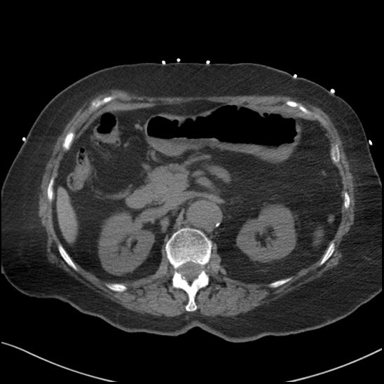 Aortic intramural hematoma with dissection and intramural blood pool (Radiopaedia 77373-89491 Axial non-contrast 108).jpg