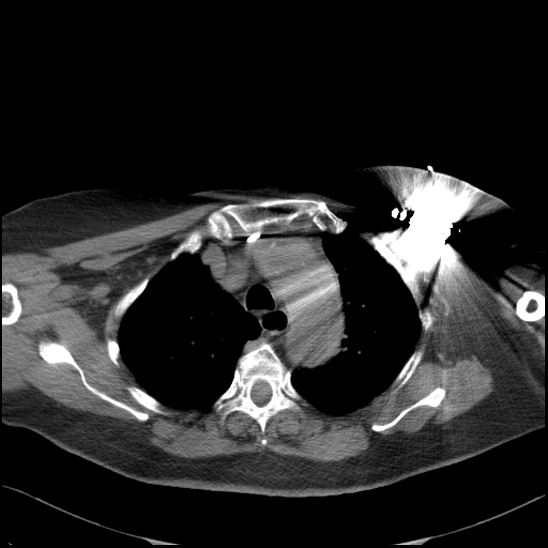 Aortic intramural hematoma with dissection and intramural blood pool (Radiopaedia 77373-89491 Axial non-contrast 26).jpg