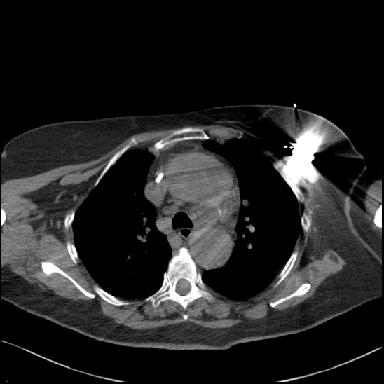 Aortic intramural hematoma with dissection and intramural blood pool (Radiopaedia 77373-89491 Axial non-contrast 33).jpg