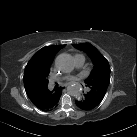 File:Aortic intramural hematoma with dissection and intramural blood pool (Radiopaedia 77373-89491 Axial non-contrast 50).jpg