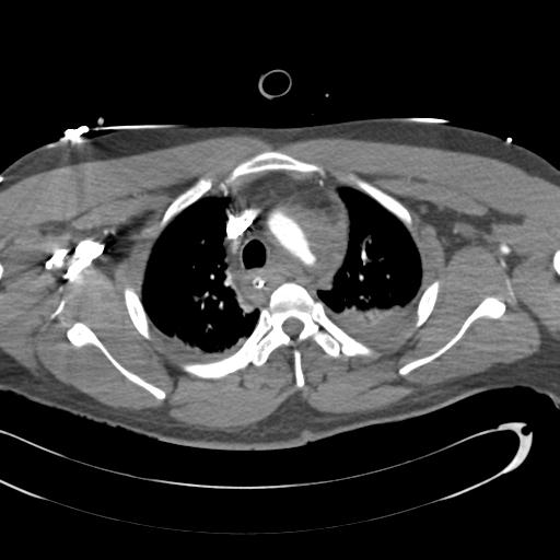 Aortic transection, diaphragmatic rupture and hemoperitoneum in a complex multitrauma patient (Radiopaedia 31701-32622 A 25).jpg