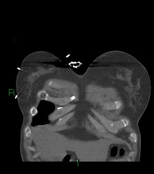 File:Aortic valve endocarditis (Radiopaedia 87209-103485 D 65).jpg